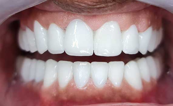 До и после лечение зубов