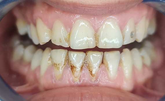 До и после лечение зубов