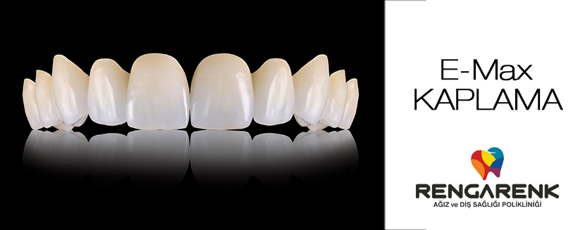 Что такое стоматологическое покрытие Emax ? 