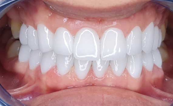 Diş Tedavisi Öncesi Sonrası