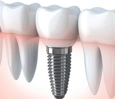 DENTAL IMPLANT