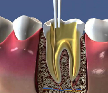 KANAL TEDAVİSİ (ENDODONTI)