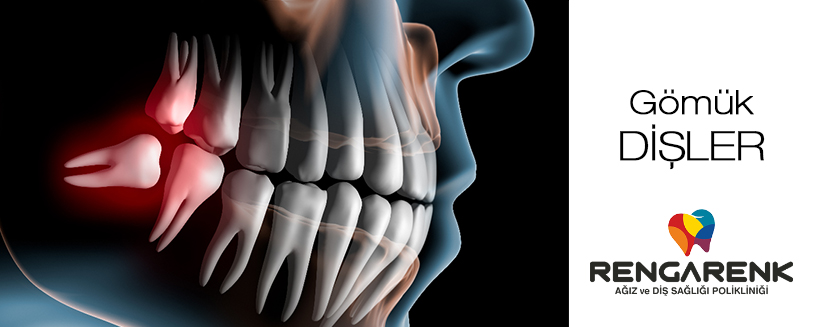 What is an embedded tooth?