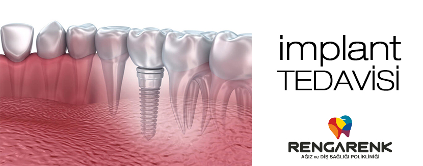 What are Dental Implants ?