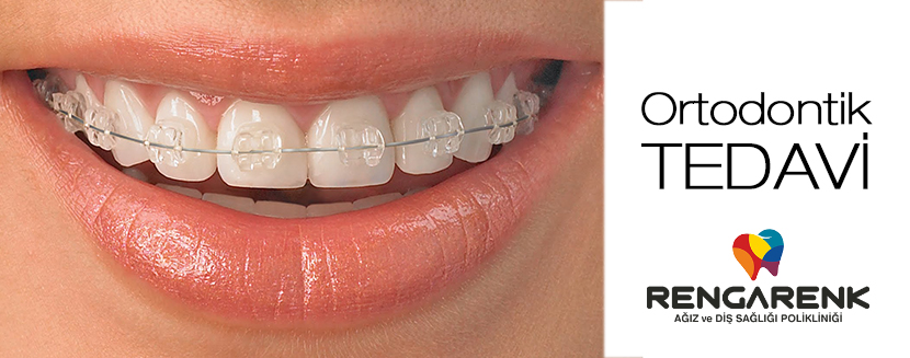 Orthodontic Treatment