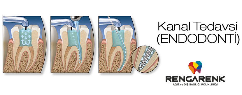 Kanal Tedavisi ( Endodonti )