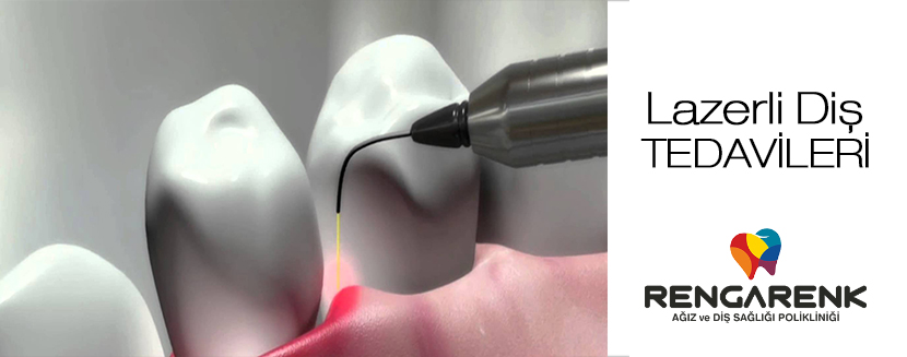 Dental treatments with laser